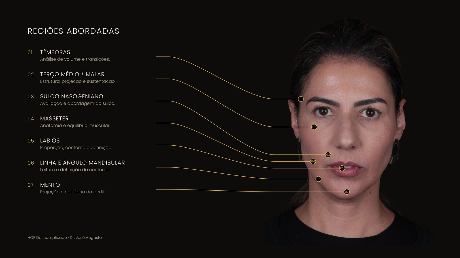 Mapa facial com as regiões abordadas no HOF Descomplicado: têmporas, terço médio e malar, sulco nasogeniano, masseter, lábios, linha e ângulo mandibular e mento.
